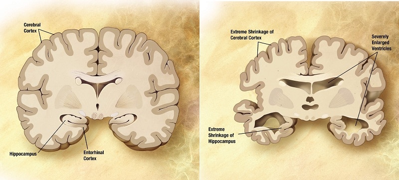 Alzheimer's diseased and healthy brain comparison